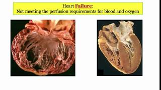 12DaysinMarch Heart Failure 1 Introduction for the USMLE Step One Exam [upl. by Liz]