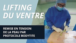 Lifting du ventre sans chirurgie par protocole BodyTite lipolyse et radiofréquence [upl. by Nevart621]