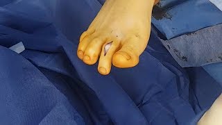 Surgical Correction of Hammertoe deformity [upl. by Leikeze748]