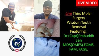 Dr Rudra Mohan  Live Wisdom Tooth Surgery  Lower Wisdom tooth Removal Dr Prabuddh Sen [upl. by Fish55]