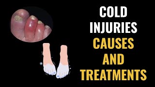 Cold Injuries Causes and Treatments [upl. by Melantha]