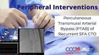 Percutaneous Transmural Arterial Bypass PTAB of Recurrent SFA CTO [upl. by Stefania58]