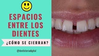 Espacios entre los dientes ¿Cómo cerrarlos Ortodoncia o Diseño de Sonrisa [upl. by Tartaglia]