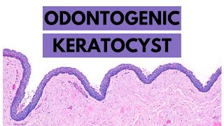 Odontogenic Keratocyst Clinical features Radiology Histology and Treatment [upl. by Eanal173]