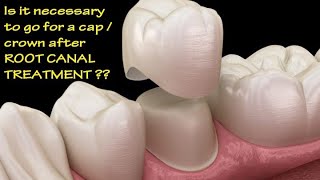 The Importance of Cap or Crown After the Root Canal Treatment [upl. by Nyrmak]