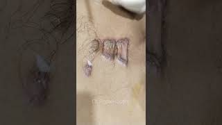 Keloid Scar Intera lesional Kenacort Steroid Injection Procedure ortho shorts injection keloid [upl. by Hebel231]