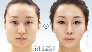 Korelilerin Estetik Ameliyatı Öncesi Ve Sonrası  korean plastic surgery before after [upl. by Sinnelg803]