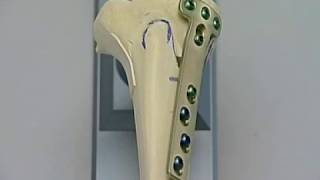 High Tibia Valgisation Osteotomy HTO Open wedge With The Tomofix System [upl. by Ylliw843]