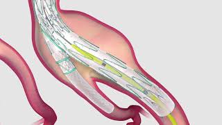 Abdominal aortic aneurysm  Usmle step 1  Causes  Signs amp symptoms  diagnosis  treatment [upl. by Drarig]