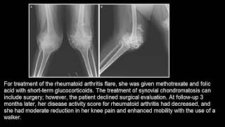Synoviale Chondromatose [upl. by Celinda]