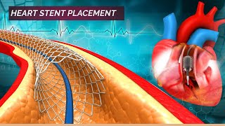 Angioplasty for Narrowing Heart Arteries  Heart Stent Placement  Stent 3D Animation [upl. by Crescin]