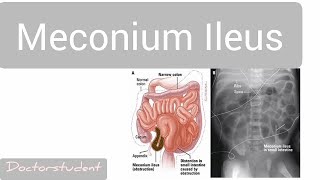 Meconium Ileus [upl. by Elicia]