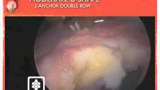 arthroscopic rotator cuff repair moderate U double row [upl. by Rothmuller]