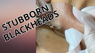 Stubborn blackheads [upl. by Eiten863]