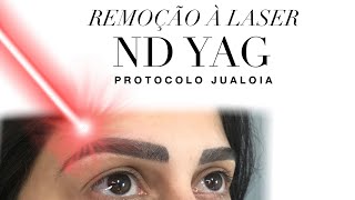 Remoção A LASER Nd YAG  Protocolo JUALOIA [upl. by Nalahs356]