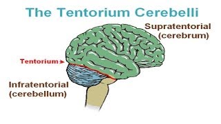 Classification of Brain Herniation [upl. by Bozovich602]