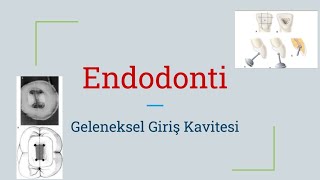 Giriş Kavitesi Prensipleri  Endodonti Dersleri [upl. by Ashatan]