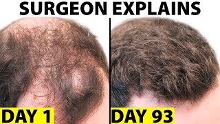 Oral Minoxidil  A Better Hair Loss Treatment [upl. by Weston]