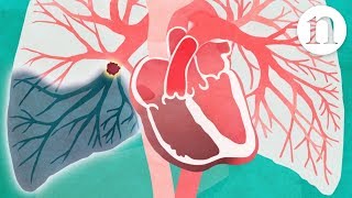 Pulmonary embolism The route to recovery [upl. by Aleksandr]