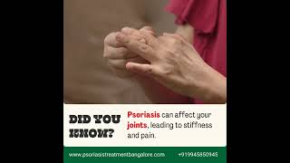 Psoriasis Can Affect Your Joints known as Psoriatic Arthritis psoriasis psoriasisawareness [upl. by Sheryl665]