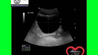 Ultrasound Board Review on Bladder Ultrasound [upl. by Nwahsyar]