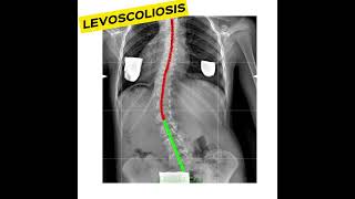 Do you have a levoscoliosisC shape curve scoliosis xrays backpain Levoscoliosis [upl. by Nickolas803]