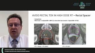 HDR brachytherapy in prostate cancer Razvan Galalae [upl. by Gahan]