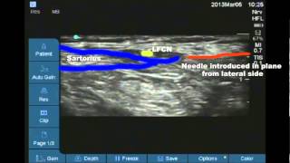 Ultrasound guided lateral femoral cutaneous nerve of thigh block [upl. by Sakmar]