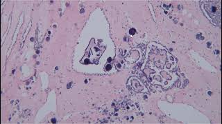 Renal Tumors Case 3 [upl. by Noorah]