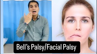 Bells Palsy  Facial Palsy Best Tips and exercise Fast Recovery Dr Pritam Singh [upl. by Anomor820]