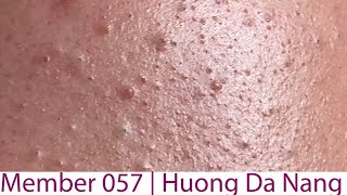 Acne Treatment Huong Da Nang 057  Member 2023 [upl. by Laet263]