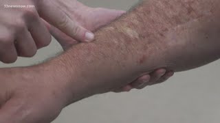 Skin Cancer How to spot melanoma warning signs [upl. by Mulcahy]