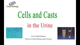 Urine analysis Part 3 cells and casts in urine sediment [upl. by Aundrea]