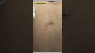 Stitch Removal Technique टांका काटना सीखें drsubhashkumar Stitchremoval Suture [upl. by Trevor]