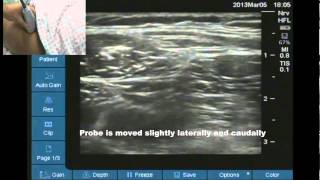 Ultrasound location of lateral femoral cutaneous nerve [upl. by Alicea217]