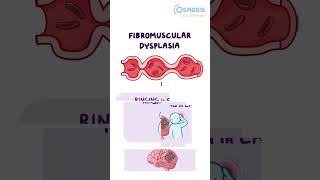 Fibromuscular Dysplasia [upl. by Ennayhs]