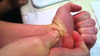 Popping a ganglion cyst [upl. by Eoj473]