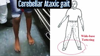 Cerebellar Ataxic Gait giving appearance of drunkenness [upl. by Aurelius932]