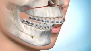 Chirurgie Maxillofaciale et orthodontie [upl. by Huppert]