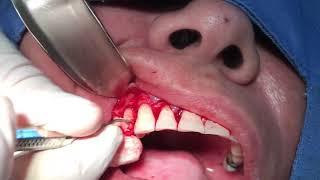 Curetaje periodontal abierto [upl. by Adnoval]