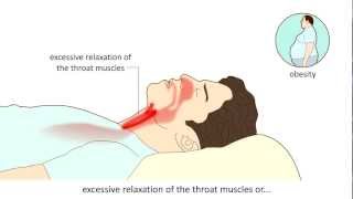 Obstructive Sleep Apnea Syndrome OSAS  Causes and treatment [upl. by Ahtel]