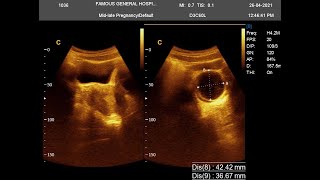 Hemorrhagic cyst USG Report with Thickened Endometrium [upl. by Titos]