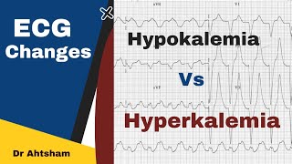 ECG findings Hypokalemia vs Hyperkalemia  Dr Ahtsham [upl. by Assirat690]