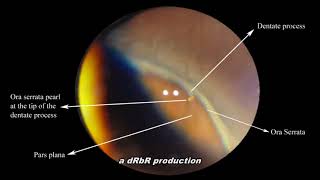 Ora Serrata pearl Scleral depression [upl. by Nosde]