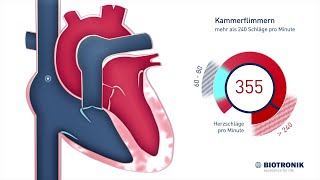 Kammerflimmern amp plötzlicher Herztod Animation [upl. by Inamik]