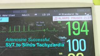 SVT or Supraventricular Tachycardia [upl. by Eyeleen812]