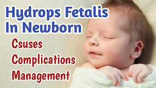 Hydrops Fetalis In Newborn Baby  Fetal Hydrops Causes Complications Treatment amp Prognosis [upl. by Eirod550]