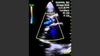 VSCAN Aortic insufficiency Pocket UltrasoundInsuficiencia aórtica [upl. by Auhs445]