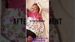 Erbs Palsy recovery from 3 months [upl. by Prakash76]