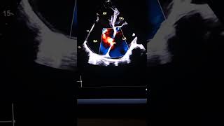 Atrial Septal Defect ASD Apical 4chamber [upl. by Markland481]